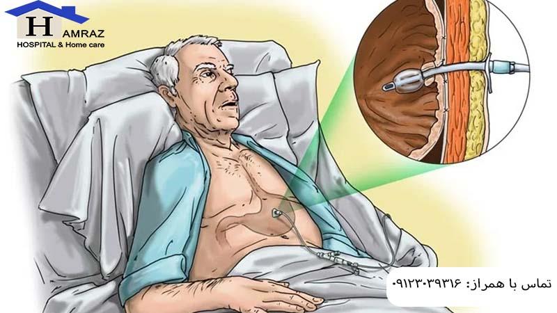 پگ معده یا گاستروستومی