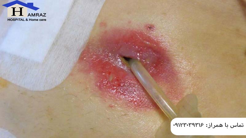 پگ معده یا گاستروستومی