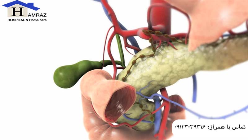 انسداد مجرای صفراوی